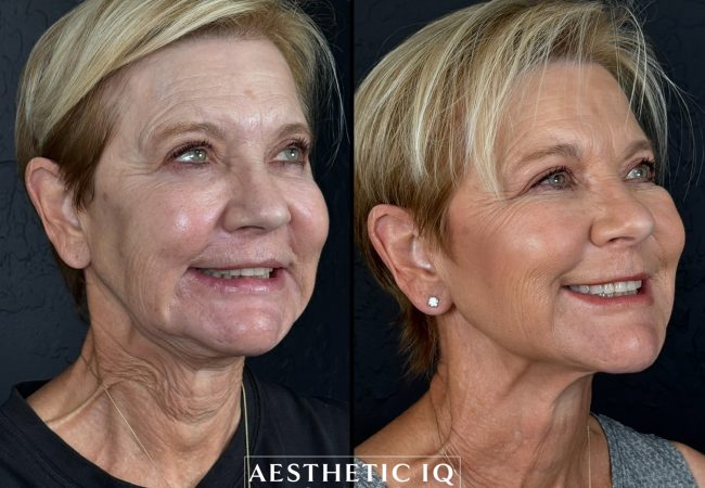 Scottsdale chin filler