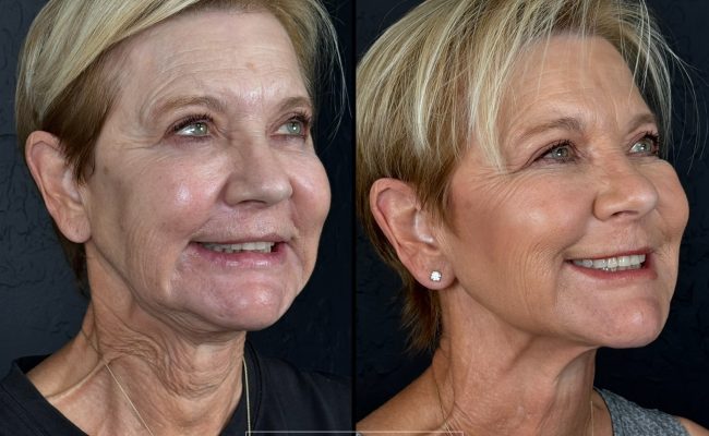 neck rejuvenation Scottsdale