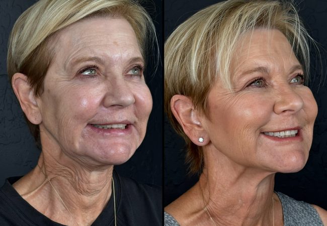 Scottsdale Cheek Filler